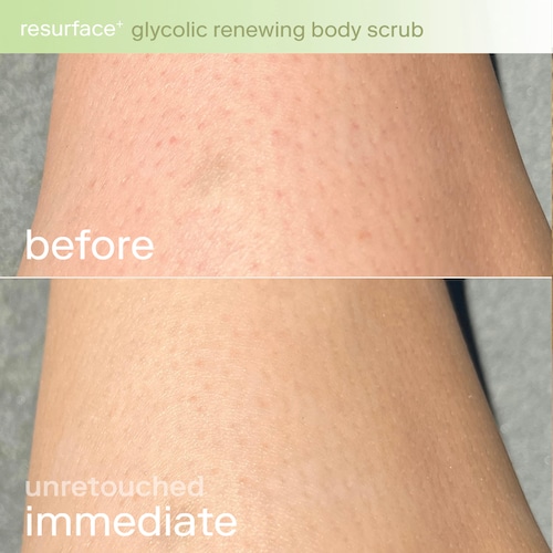 Glycolic and lactic acids are two commonly used exfoliating ingredients in skincare products. These acids are known for their ability to gently remove dead skin cells, revealing smoother and brighter skin. One such product that harnesses the power of these acids is the Resurface+ Glycolic and Lactic Acid Renewing Body Scrub.