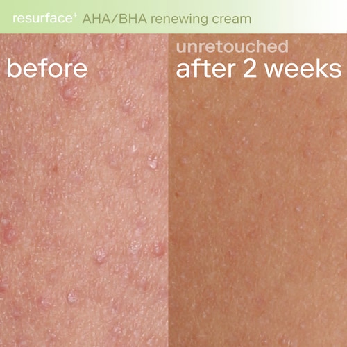 By incorporating AHAs into a body cream formula, Resurface+ AHA Renewing Body Cream aims to address common skin concerns such as roughness, dryness, uneven skin tone, and texture irregularities. Regular use of this body cream can help improve the appearance of skin affected by sun damage, aging, or environmental factors.