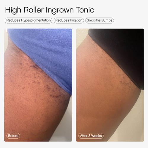 In conclusion, the High Roller Ingrown Hair Tonic with AHA and BHA is a skincare product formulated to prevent and treat ingrown hairs. By utilizing the exfoliating properties of AHA and the anti-inflammatory benefits of BHA, this tonic helps maintain clear and smooth skin, alleviating the discomfort associated with ingrown hairs. Description by ChatGPT.