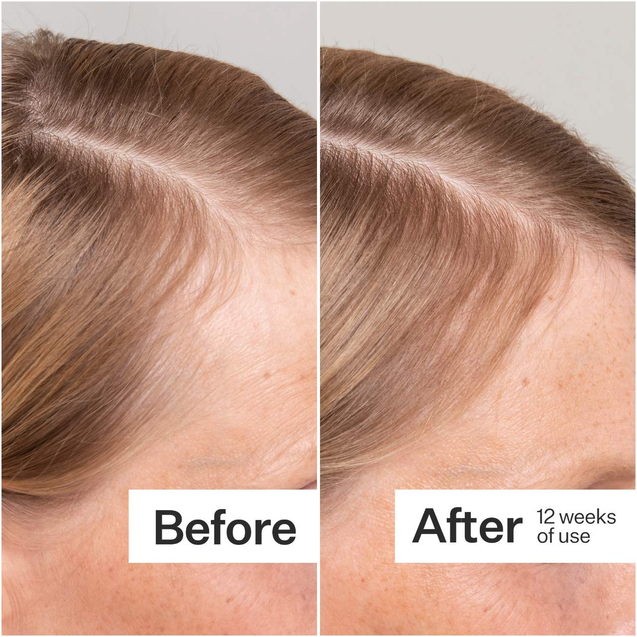 2% Stem Cell H-2 Grow Complex ™ Scalp Serum For Thinning Hair