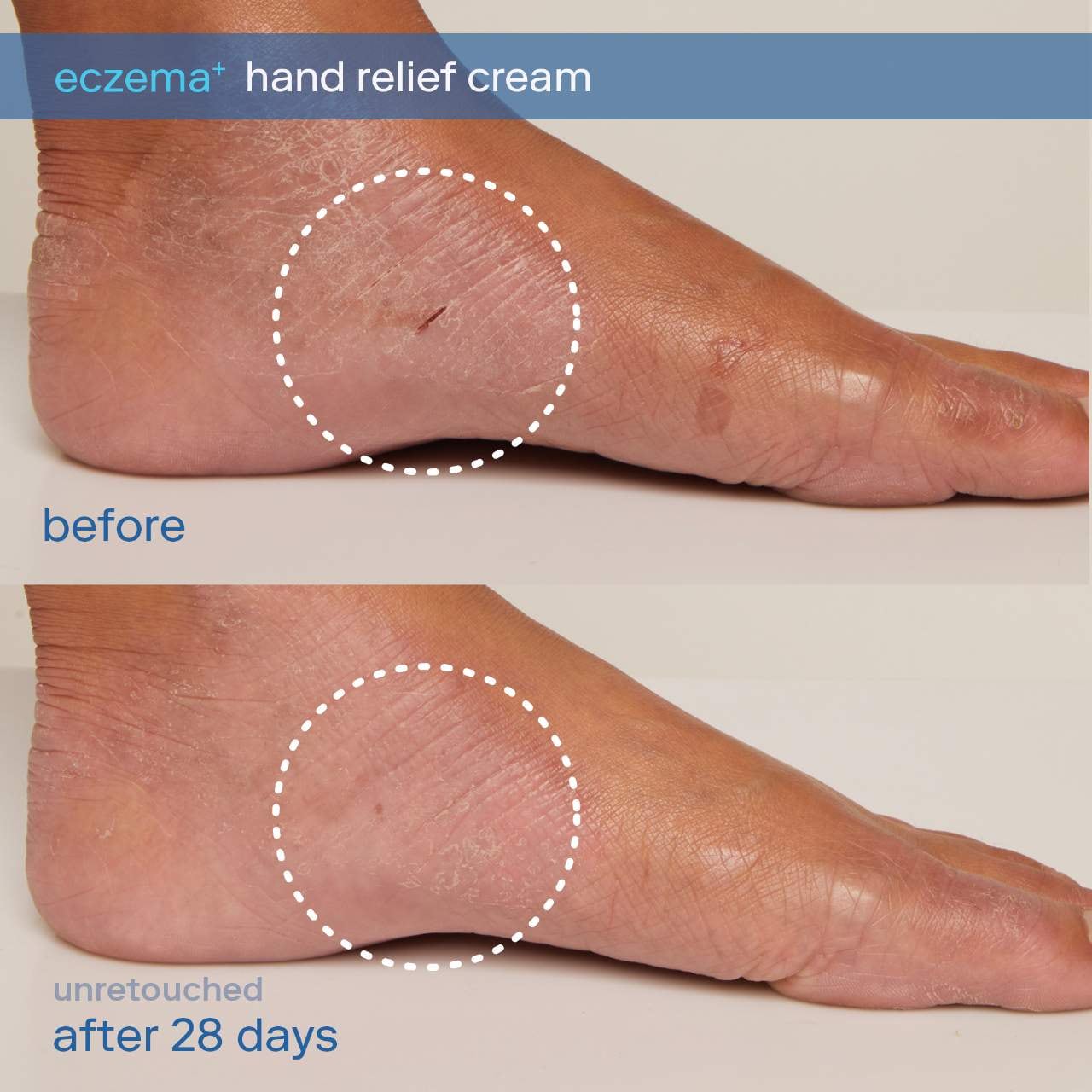 Eczema+ Ceramide Hand + Foot Relief Cream