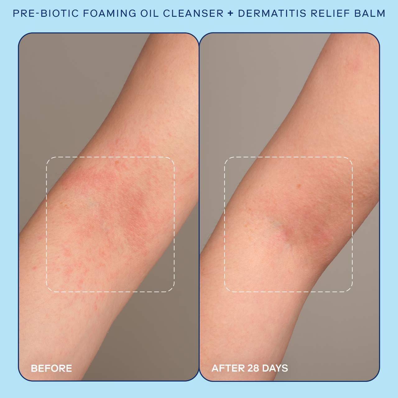 Eczema+ Pre-Biotic Foaming Oil Cleanser