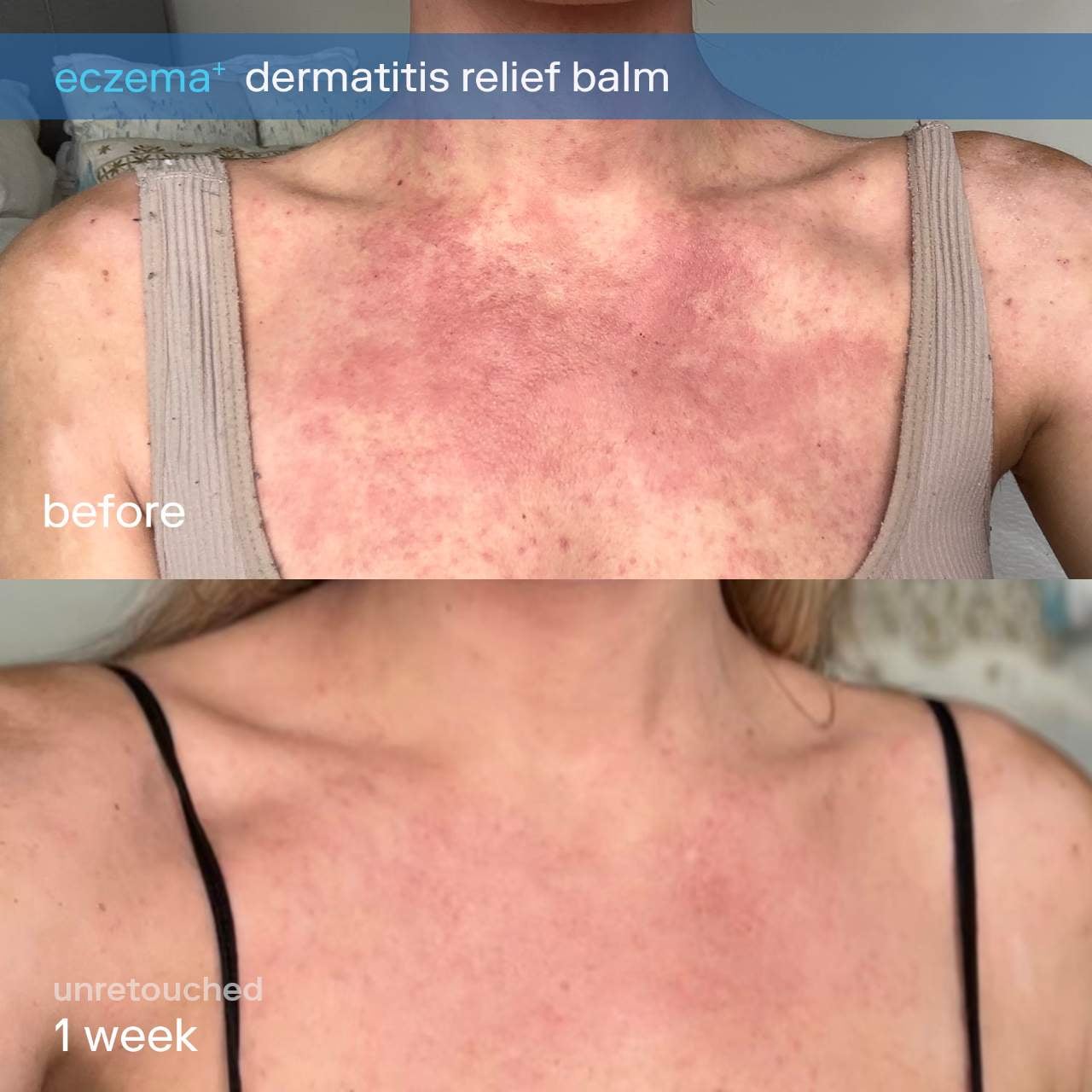 eczema+ Dermatitis Ceramide Face + Body Cream