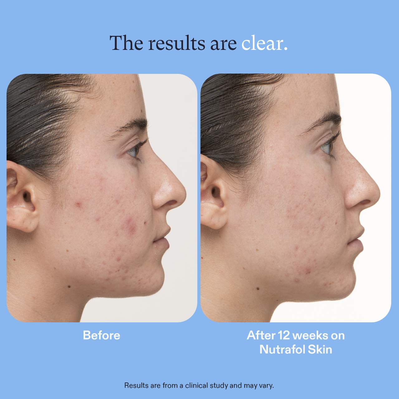 Clear Skin Physician-formulated Acne & Post-acne Dark Spot Supplement for Women