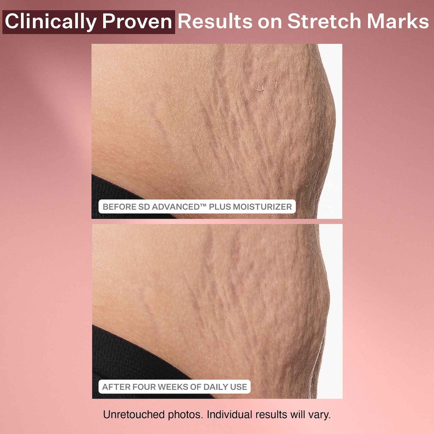 SD Advanced™ PLUS Intensive Moisturizer for Stretchmarks and Wrinkles