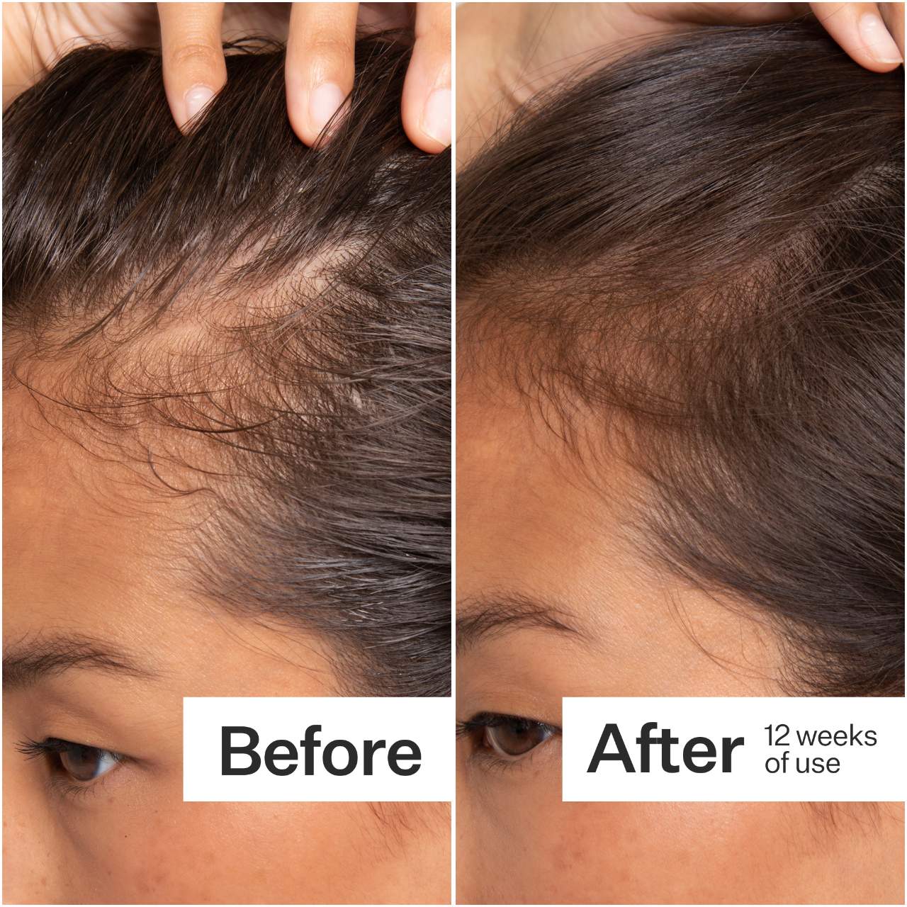 2% Stem Cell H-2 Grow Complex ™ Scalp Serum For Thinning Hair