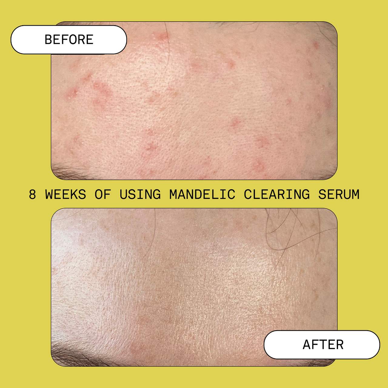 Mandelic Acid Exfoliating & Clearing Serum