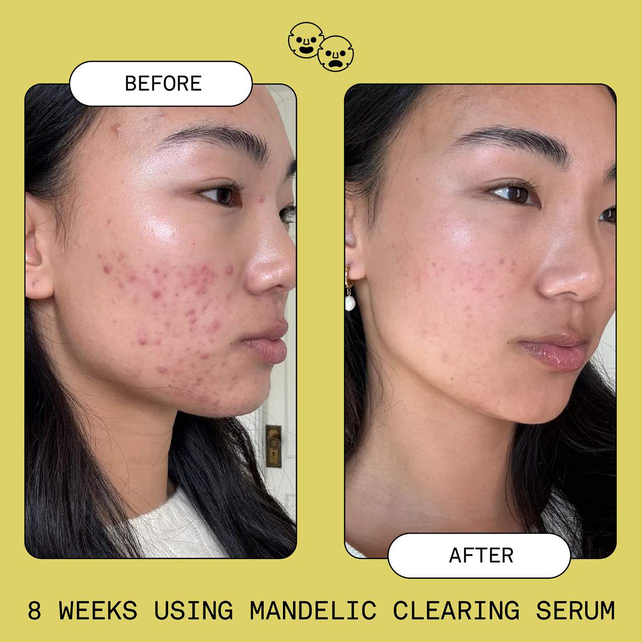 Mandelic Acid Exfoliating & Clearing Serum